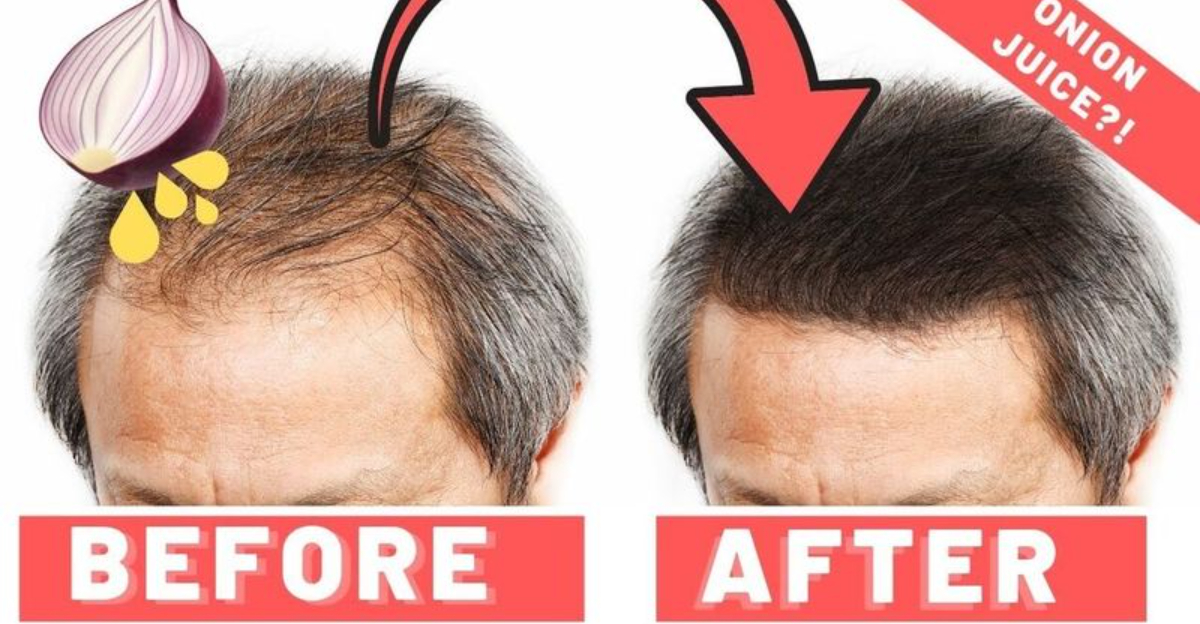 29 All Natural Remedies For Balding