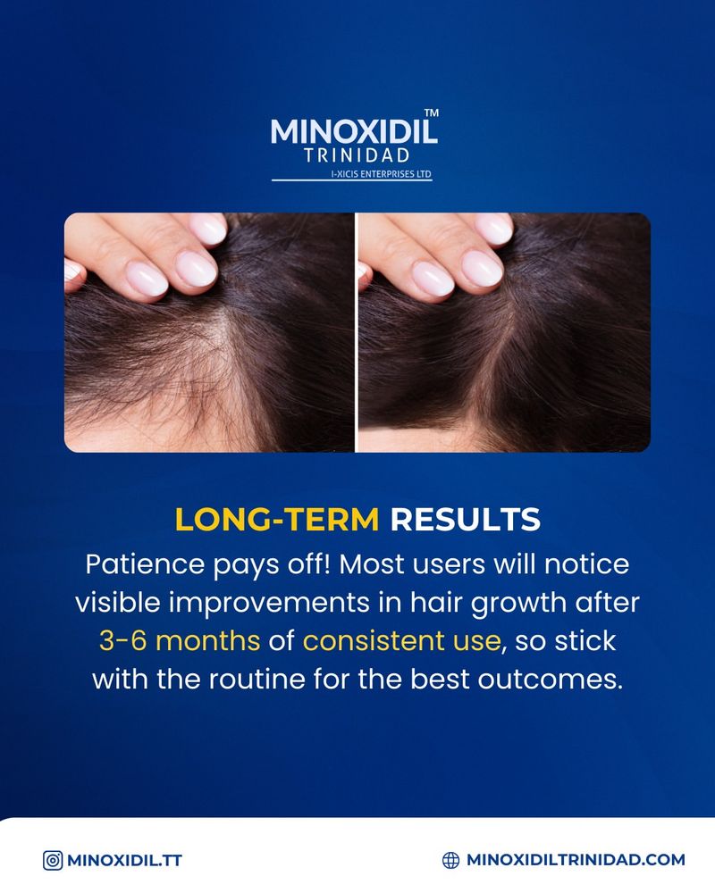 Use Minoxidil