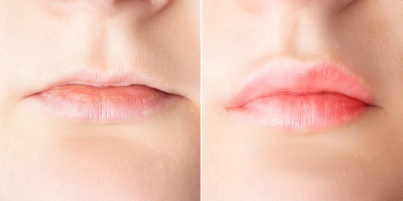Skipping Lip Prep