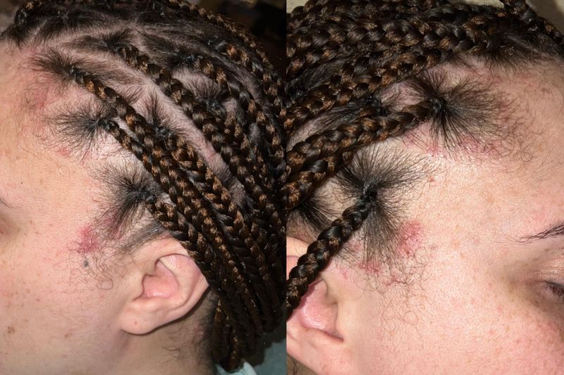 Scalp Irritation Ignored