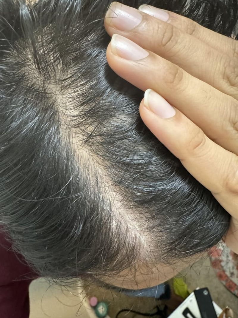 Skimping on Scalp Care