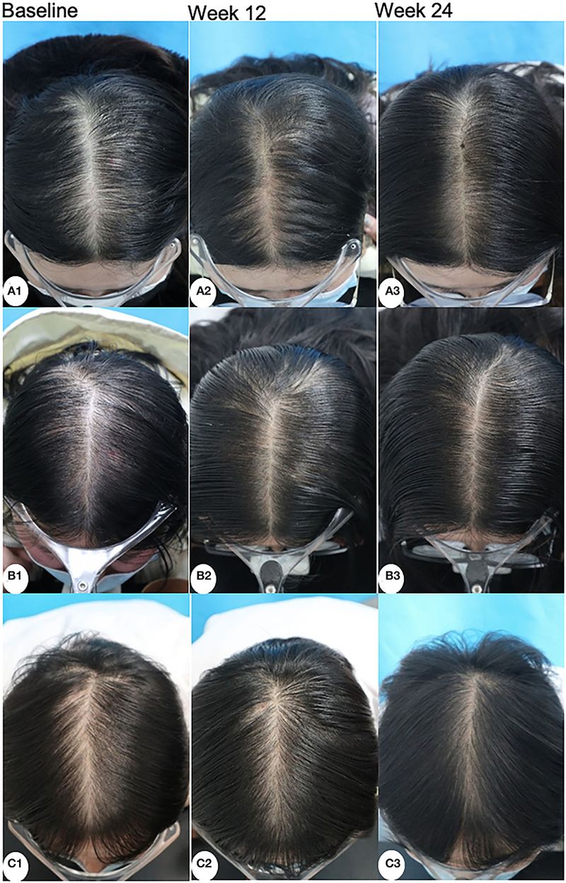 Minoxidil-Based Treatments